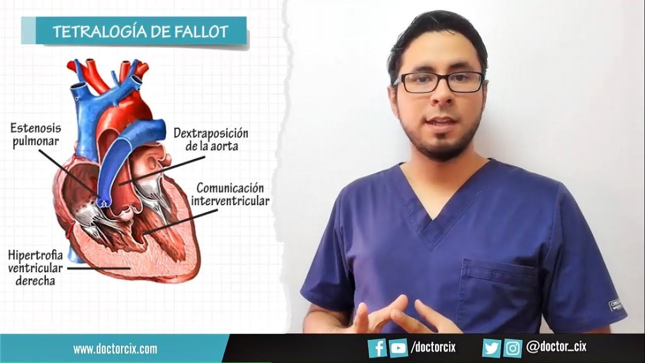 TETRALOGIA DE FALLOT