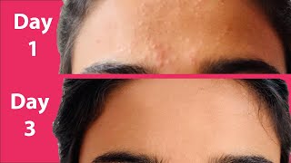 ACNE Treatment At Home | 3 day Acne REMOVAL Challenge | Acne Treatment Ayurvedic with Results - CHALLENGE