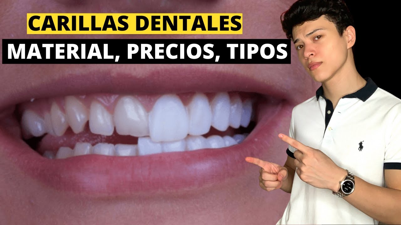 LO QUE DEBES SABER ANTES DE PONERTE CARILLAS DENTALES (MATERIAL, COSTO, TIPOS DE CARILLAS DENTALES)