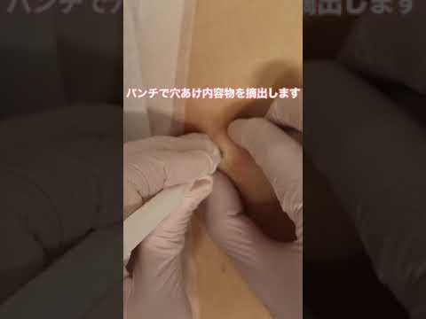 ICD-10 第 02 章: 腫瘍について詳しく解説