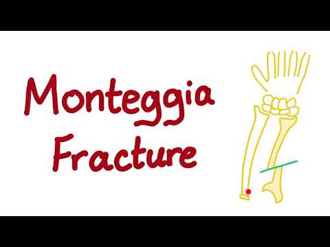 Monteggia Fracture - Fracture of the Ulna Bone 🦴- Orthopedic Surgery