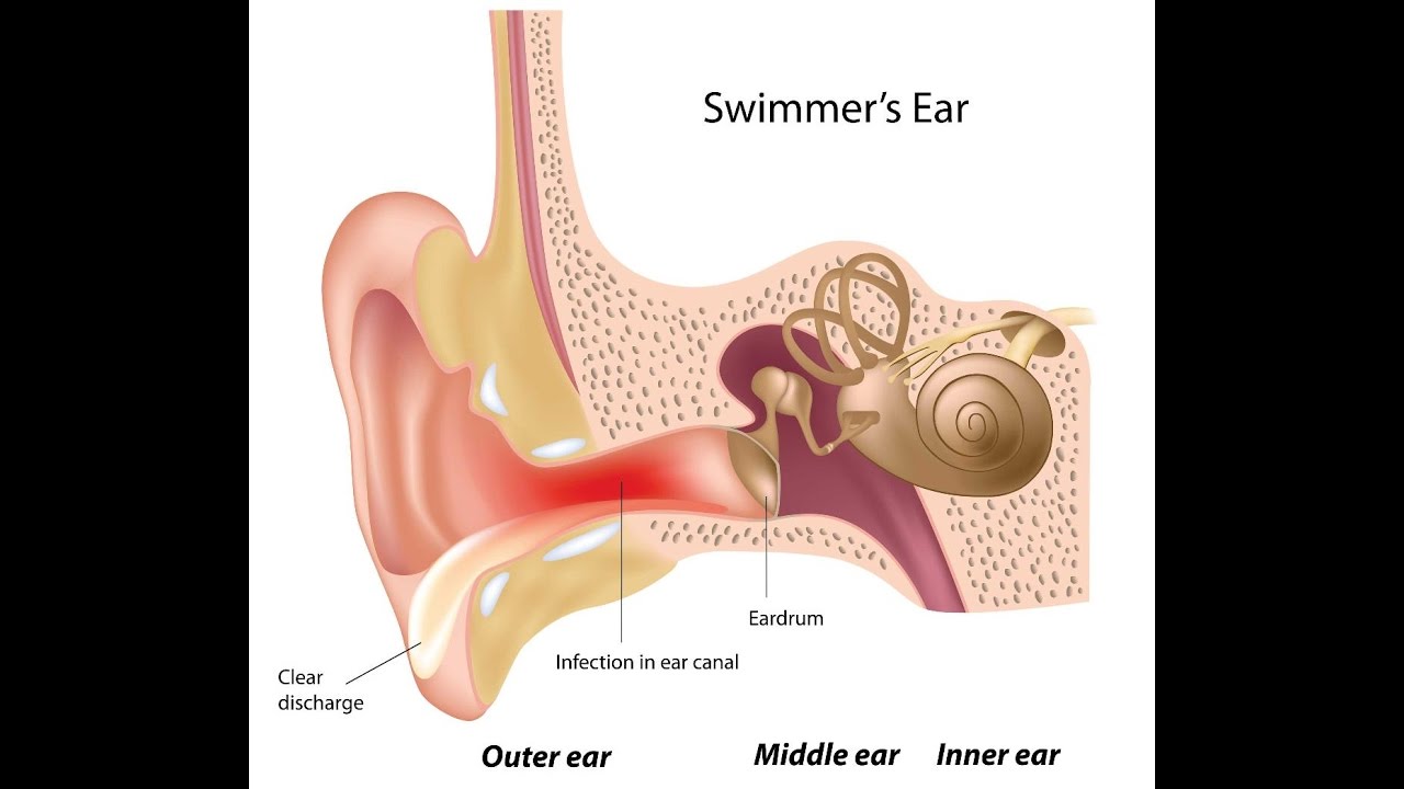 Otitis Externa - YouTube
