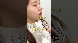 짧은 턱에 효과 좋은 턱필러