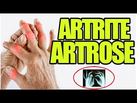 What is ARTHRITIS? Understand everything about ARTHRITIS and OSTEOARTHRITIS