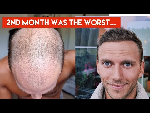 My Hair Transplant Journey - The AWFUL first 4 months...