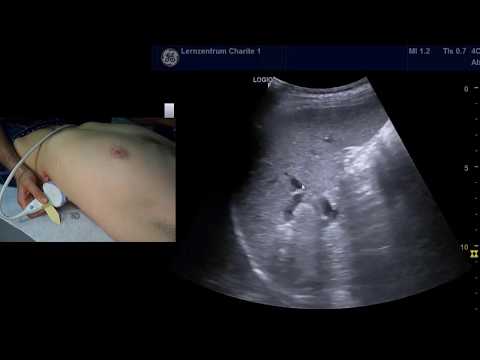 Sonographie der Milz