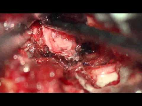Spalla osteocondrite esfoliante ocd congiunta nei cani Giunto falso in traumatologia