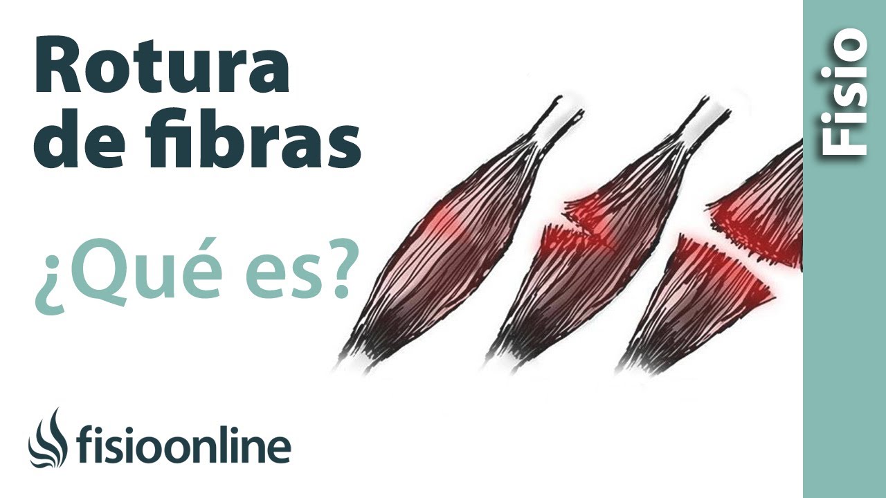 Watch Roturas de fibras o musculares - Qué son, cómo suceden y cómo se reparan Now Roturas de fibras o musculares - Qué son, cómo suceden y cómo se reparan