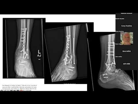 Managing AVN of the talus using a Blair Arthrodesis