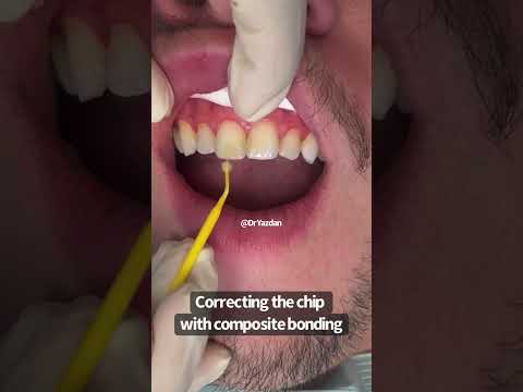 Fixing a chipped front tooth | composite bonding | Cosmetic Dentist Dr Yazdan