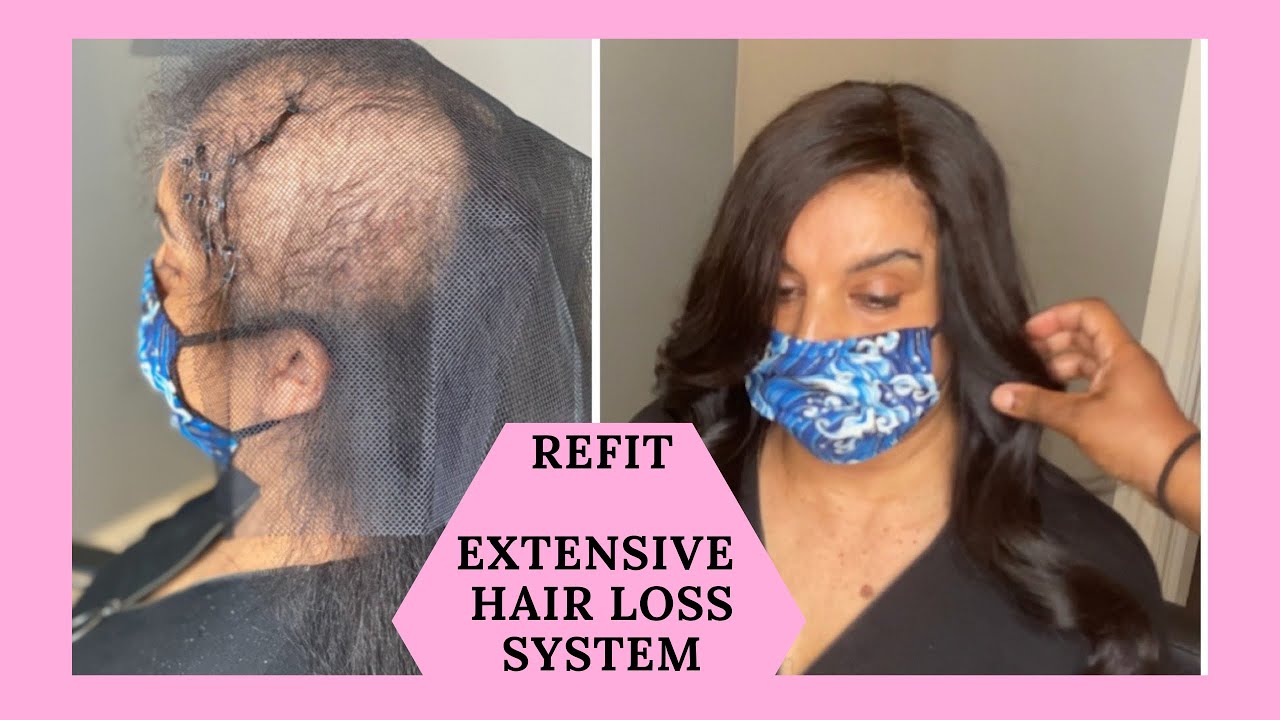 REFIT of our CROWN HAIR LOSS SYSTEM