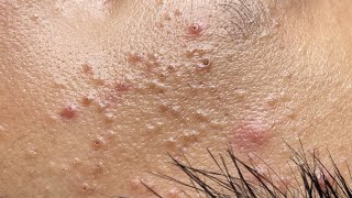 Soothing Facial Treatment for Acne-Prone Skin 643 P1