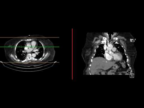 Massive Pulmonary Embolism on CT