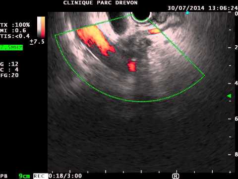 EUS PANCREATIC CARCINOMA