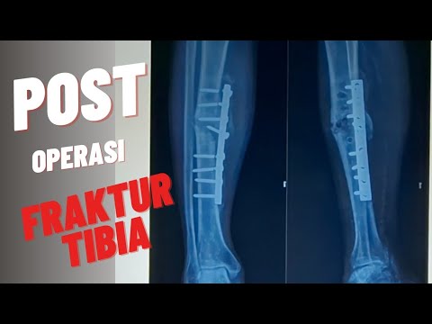 Pasca operasi patah tulang tibia