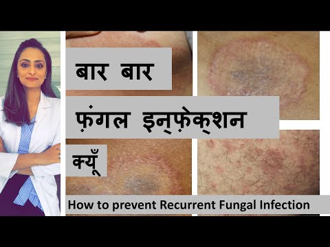 बार बार फ़ंगल इन्फ़ेक्शन क्यूँ होता है ? कैसे बचे? Recurrent fungal infection treatment