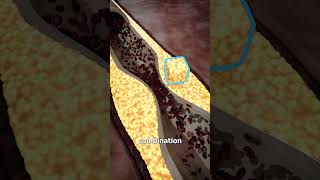 The Biology Of A Heart Attack 🫀