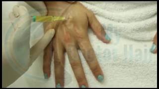 أبر بلازما للوجه والرقبة واليدين