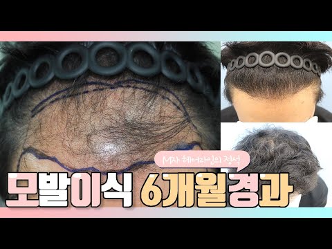 40대 후반 남성,비절개,4200모,M자 모발이식 6개월 경과영상!