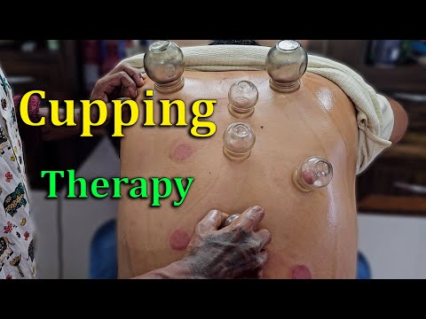 Master Cracker’s Intense Back Cupping Massage for Pain Relief