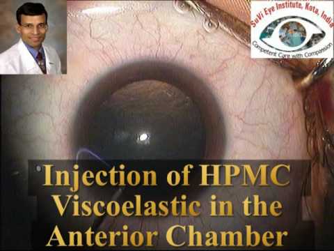Correction Of High Myopia By Phakic Lens Implantation