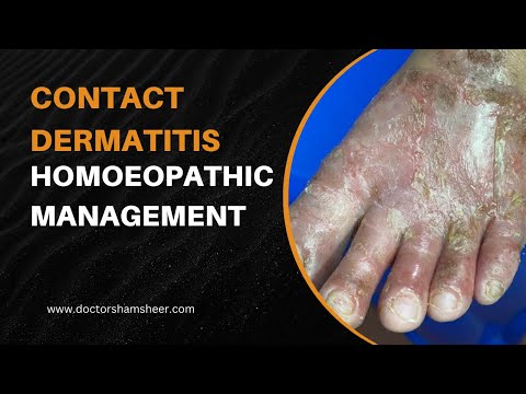 Contact dermatitis