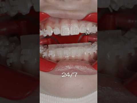 9 million people do what?? 🤯🤯 #Braces #LightForce #Orthodontics #BracesJourney #smile #short