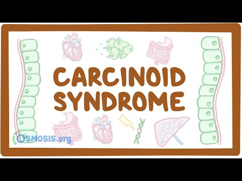 Carcinoid Syndrome - causes, symptoms, diagnosis, treatment, pathology