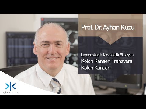 Laparoskopik Mezokolik Eksizyon- Kolon Kanseri- Transvers Kolon Kanseri