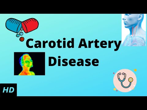 CAROTID ARTERY DISEASE, Causes, Signs and Symptoms, Diagnosis and Treatment.