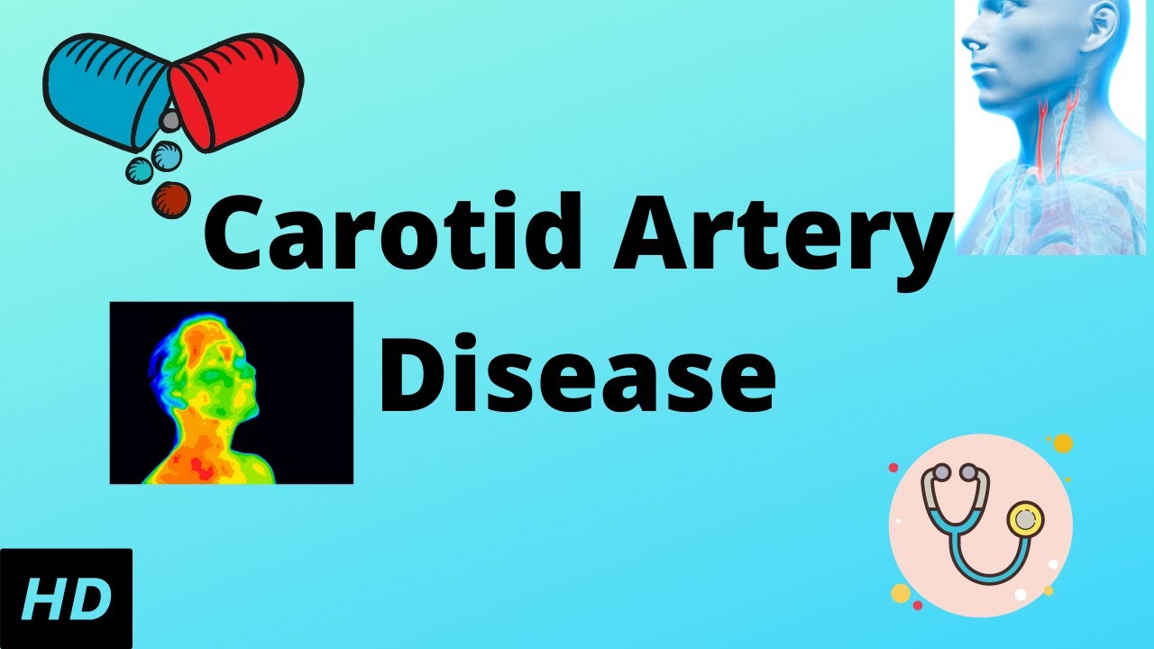 CAROTID ARTERY DISEASE, Causes, Signs and Symptoms, Diagnosis and Treatment.