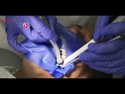 Treating a cavity without devitalizing the tooth - The Health Magazine