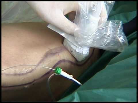 L'occlusion endoveineuse par laser (EVLO) avec Venex de KLS Martin (part 2)
