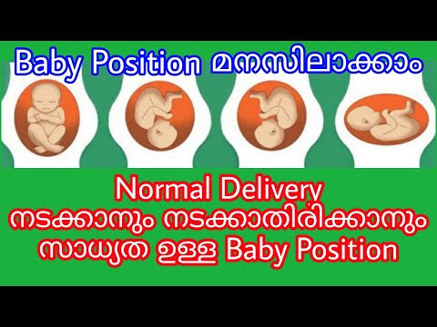 Baby Position During Pregnancy || Which Baby Position Helps for Normal Delivery in malayalam