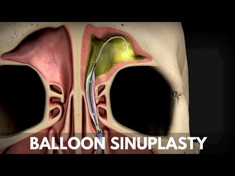 Balloon Sinuplasty with Dr. Latif Dharamsi