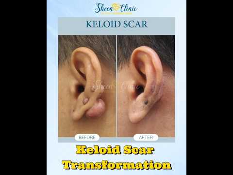 Keloid Scar Treatment Results | Flatten & Fade Raised Scars