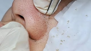 Satisfying Relaxing Skin Deep Clean : Halo Skin Hong Kong:  Acne and Blackheads 黑頭粉刺  #Shorts