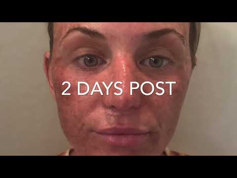 DOT LASER SKIN RESURFACING: RECOVERY