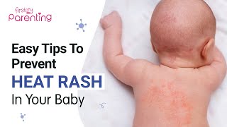 How to Treat and Prevent Heat Rash in Babies
