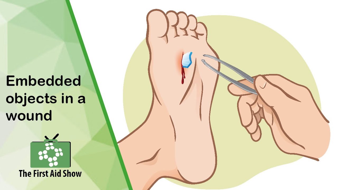 First aid for an embedded objects in a wound