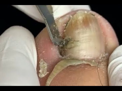 Thick toenail treatment