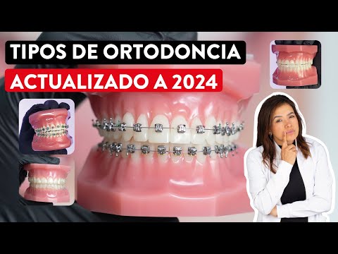 Tipos de Ortodoncia actualizado a 2024 ✅