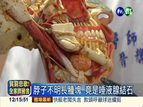 脖子腫塊雞蛋大 女子唾液腺結石