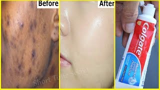 In 2 DAYS-Remove DARK SPOTS  With  Toothpaste |Apply Toothpaste on Your Darkspots and See the Magic