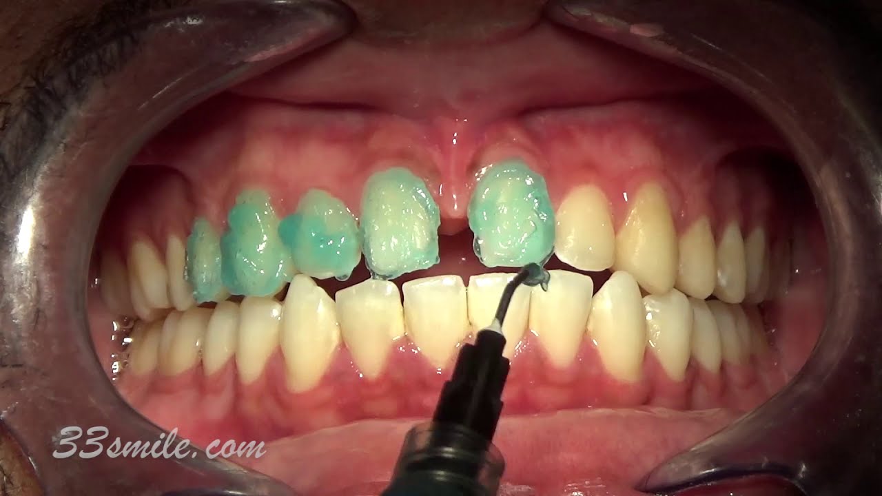 Prepless porcelain dental veneers. Cosmetic dentistry. Before and after to fix gap.