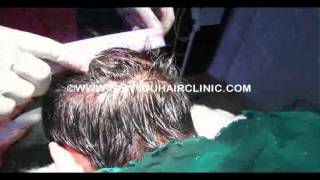 preview picture of video 'FUT Hair Transplant Surgery in India'