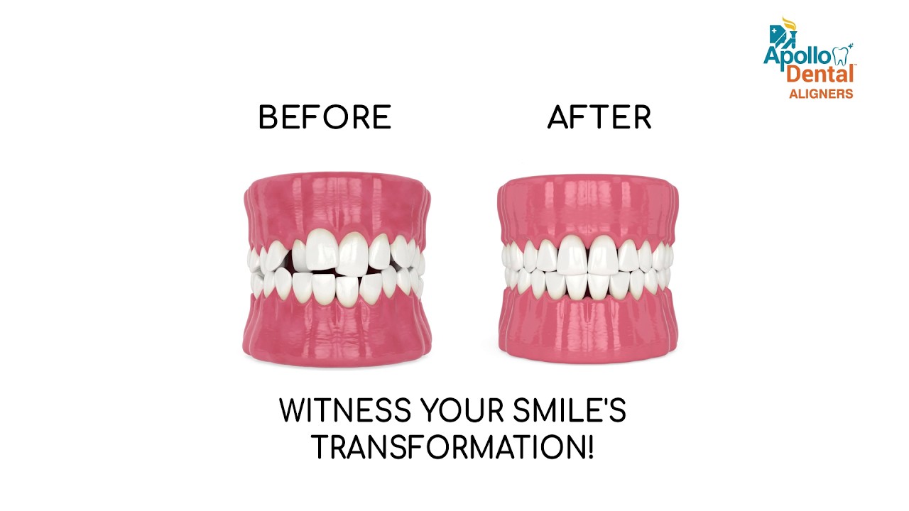 Apollo Dental Aligners: See How They Work!
