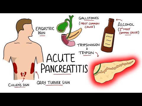 Acute Pancreatitis Causes Signs Symptoms Pathophysiology Diagnosis