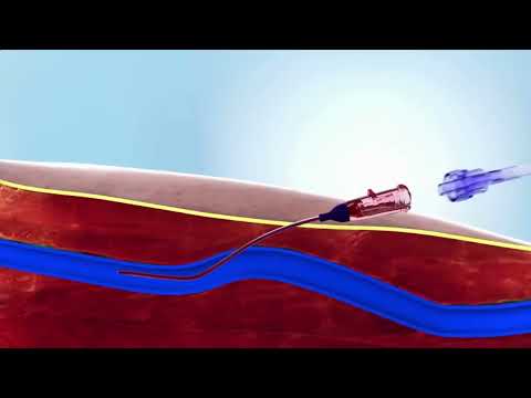 Peripheral IV catheter insertion (Medical Animation)