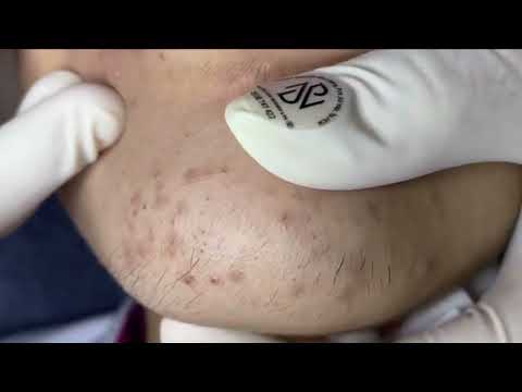 Acne On Girl's Chin | Acne Treatment Nhat Bang